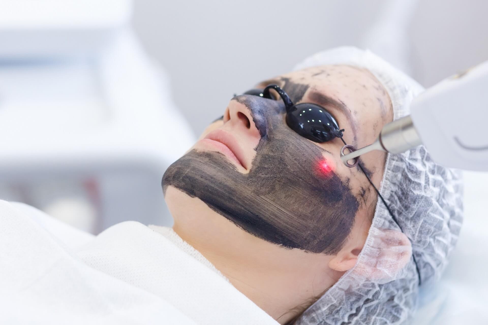 Karbon Peeling Ne İşe Yarar? Faydaları Zararları ve Yan Etkileri Nelerdir? blog-image