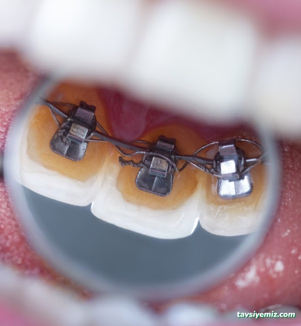 Dr Burak Aksu Ortodonti Uzmanı Dr Burak Aksu Ortodonti Uzmanı
