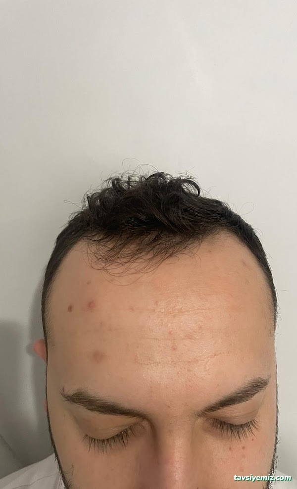 İbrahim Erayhan-Saç Ekimi-Bursa Tıp Merkezi - Hairtransplant Clinic İbrahim Erayhan-Saç Ekimi-Bursa Tıp Merkezi - Hairtransplant Clinic