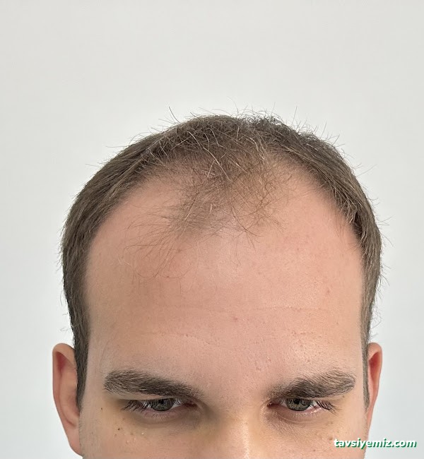 İbrahim Erayhan-Saç Ekimi-Bursa Tıp Merkezi - Hairtransplant Clinic İbrahim Erayhan-Saç Ekimi-Bursa Tıp Merkezi - Hairtransplant Clinic