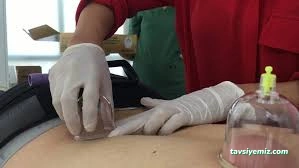 Akupunktur Burdur Akupunktur Burdur