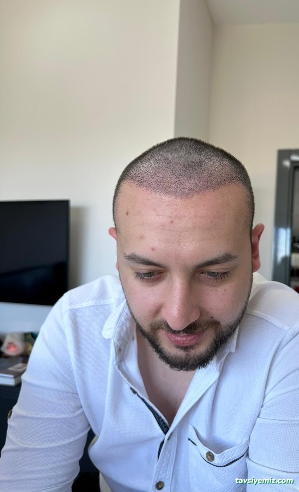 İbrahim Erayhan-Saç Ekimi-Bursa Tıp Merkezi - Hairtransplant Clinic İbrahim Erayhan-Saç Ekimi-Bursa Tıp Merkezi - Hairtransplant Clinic