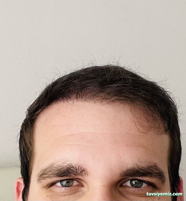 İbrahim Erayhan-Saç Ekimi-Bursa Tıp Merkezi - Hairtransplant Clinic İbrahim Erayhan-Saç Ekimi-Bursa Tıp Merkezi - Hairtransplant Clinic