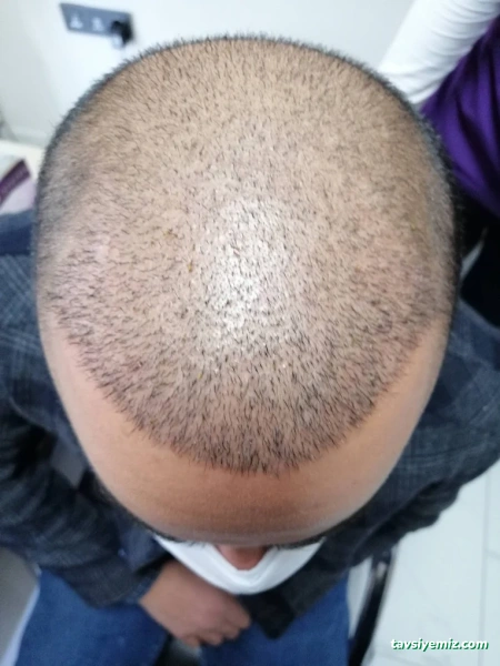 Estewolf Hair Kayseri Saç Ekimi Estewolf Hair Kayseri Saç Ekimi