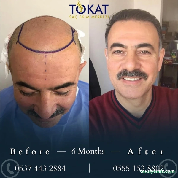 Tokat Saç Ekimi Merkezi | Tokat Hair Clinic Tokat Saç Ekimi Merkezi | Tokat Hair Clinic